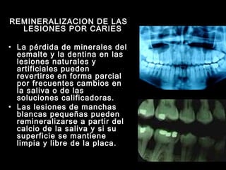REMINERALIZACION DE LAS LESIONES POR CARIES La pérdida de minerales del esmalte y la dentina en las lesiones naturales y artificiales pueden revertirse en forma parcial por frecuentes cambios en la saliva o de las soluciones calificadoras. Las lesiones de manchas blancas pequeñas pueden remineralizarse a partir del calcio de la saliva y si su superficie se mantiene limpia y libre de la placa. 