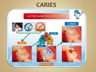 CARIES