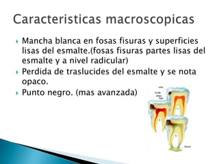 





Mancha blanca en fosas fisuras y superficies
lisas del esmalte.(fosas fisuras partes lisas del
esmalte y a nivel radicular)
Perdida de traslucides del esmalte y se nota
opaco.
Punto negro. (mas avanzada)

 
