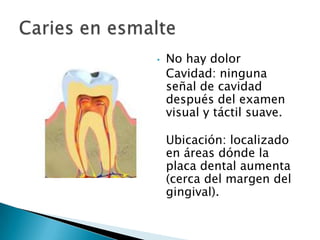 •
•

•

No hay dolor
Cavidad: ninguna
señal de cavidad
después del examen
visual y táctil suave.

Ubicación: localizado
en áreas dónde la
placa dental aumenta
(cerca del margen del
gingival).

 