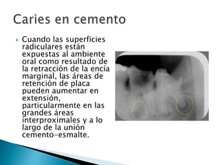 

Cuando las superficies
radiculares están
expuestas al ambiente
oral como resultado de
la retracción de la encía
marginal, las áreas de
retención de placa
pueden aumentar en
extensión,
particularmente en las
grandes áreas
interproximales y a lo
largo de la unión
cemento-esmalte.

 