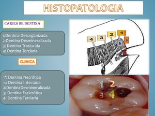 CARIES DE DENTINA

1:Dentina Desorganizada
2:Dentina Desmineralizada
3: Dentina Traslucida
4: Dentina Terciaria

1ª: Dentina Necrótica
1b: Dentina Infectada
2:DentinaDesmineralizada
3: Dentina Esclerótica
4: Dentina Terciaria

b

a

 