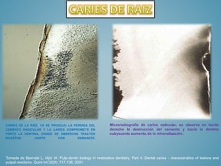 CARIES DE LA RAÍZ. YA SE PRODUJO LA PÉRDIDA DEL
CEMENTO RADICULAR Y LA CARIES COMPROMETE EN
PARTE LA DENTINA, DONDE SE OBSERVAN TRACTOS
MUERTOS.
CORTE
POR
DESGASTE.

Microradiografía de caries radicular, se observa en borde
derecho la destrucción del cemento y hacia la dentina
subyacente aumento de la mineralización.

Tomada de Bjorndal L, Mjör IA. Pulp-dentin biology in restorative dentistry. Part 4: Dental caries - characteristics of lesions and
pulpal reactions. Quint Int 32(9): 717-736, 2001

 