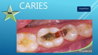 CARIES PowerPoint
 