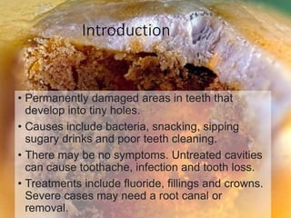 Introduction
• Permanently damaged areas in teeth that
develop into tiny holes.
• Causes include bacteria, snacking, sipping
sugary drinks and poor teeth cleaning.
• There may be no symptoms. Untreated cavities
can cause toothache, infection and tooth loss.
• Treatments include fluoride, fillings and crowns.
Severe cases may need a root canal or
removal.
 