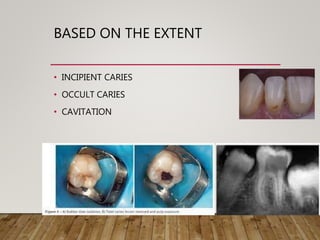 BASED ON THE EXTENT
• INCIPIENT CARIES
• OCCULT CARIES
• CAVITATION
 