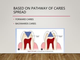 BASED ON PATHWAY OF CARIES
SPREAD
• FORWARD CARIES
• BACKWARDS CARIES
 