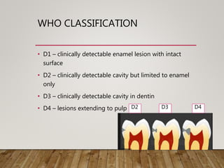 WHO CLASSIFICATION
• D1 – clinically detectable enamel lesion with intact
surface
• D2 – clinically detectable cavity but limited to enamel
only
• D3 – clinically detectable cavity in dentin
• D4 – lesions extending to pulp D2 D3 D4
 