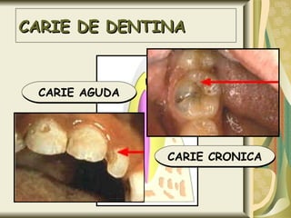 CARIE DE DENTINA CARIE AGUDA CARIE CRONICA 