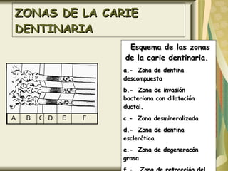 ZONAS DE LA CARIE DENTINARIA Esquema de las zonas de la carie dentinaria.  a.-  Zona de dentina descompuesta b.-  Zona de invasión bacteriana con dilatación ductal. c.-  Zona desmineralizada d.-  Zona de dentina esclerótica e.-  Zona de degeneracón grasa f.-  Zona de retracción del proceso odontoblástico . A B C D E F 