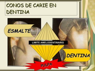 CONOS DE CARIE EN DENTINA ESMALTE  LIMITE AMELODENTINARIO  DENTINA PULPA 