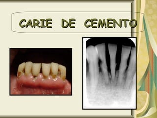 CARIE  DE  CEMENTO 