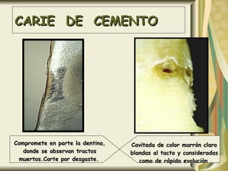 CARIE  DE  CEMENTO Compromete en parte la dentina, donde se observan tractos muertos.Corte por desgaste.   Cavitada de color marrón claro blandas al tacto y consideradas como de rápida evolución   