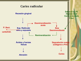Recesión gingival Sup. Radicular sana y expuesta Ácidos y fuerzas físicas Abrasión Remineralización Saliva (Ca y P) Higiene Oral Control de dieta Flúor P. Bact. + carbohidr. Desmineralización ácida Raíz Desmineralizada Degradación matriz (colágeno o PnC) Caries Caries radicular 