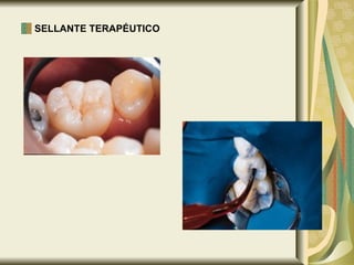 SELLANTE TERAPÉUTICO   