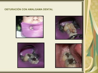 OBTURACIÓN CON AMALGAMA DENTAL   