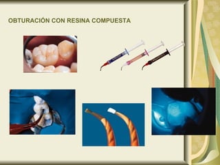 OBTURACIÓN CON RESINA COMPUESTA   