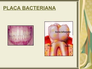 PLACA BACTERIANA   