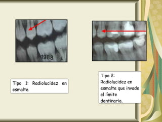 Tipo 1: Radiolucidez en esmalte . Tipo 2: Radiolucidez en esmalte que invade el límite dentinario. 