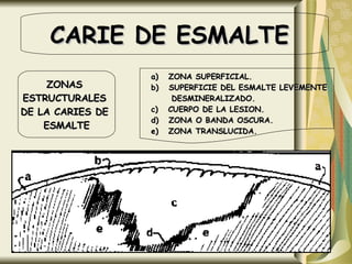 CARIE DE ESMALTE  ZONAS  ESTRUCTURALES  DE LA CARIES DE  ESMALTE a)  ZONA SUPERFICIAL. b)  SUPERFICIE DEL ESMALTE LEVEMENTE  DESMINERALIZADO. c)  CUERPO DE LA LESION. d)  ZONA O BANDA OSCURA. e)  ZONA TRANSLUCIDA. 