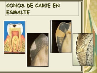 CONOS DE CARIE EN ESMALTE 
