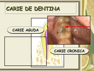 CARIE DE DENTINA


 CARIE AGUDA




               CARIE CRONICA
 