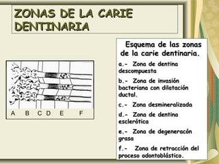 ZONAS DE LA CARIE
DENTINARIA
                       Esquema de las zonas
                      de la carie dentinaria.
                      a.- Zona de dentina
                      descompuesta
                      b.- Zona de invasión
                      bacteriana con dilatación
                      ductal.
                      c.- Zona desmineralizada
A   B   C D   E   F   d.- Zona de dentina
                      esclerótica
                      e.- Zona de degeneracón
                      grasa
                      f.- Zona de retracción del
                      proceso odontoblástico.
 