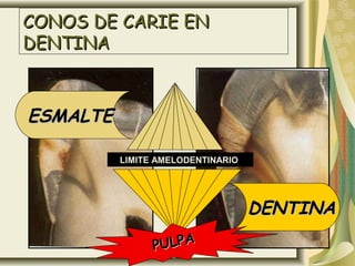 CONOS DE CARIE EN
DENTINA



ESMALTE

          LIMITE AMELODENTINARIO




                                   DENTINA
                PULPA
 