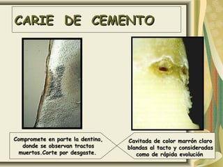 CARIE DE CEMENTO




Compromete en parte la dentina,   Cavitada de color marrón claro
   donde se observan tractos      blandas al tacto y consideradas
 muertos.Corte por desgaste.         como de rápida evolución
 