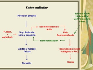 Caries radicular
                                                                  Saliva (Ca y P)
             Recesión gingival                                     Higiene Oral
                                                                 Control de dieta
                                                                       Flúor

                                 Desmineralización
                                      ácida
 P. Bact.     Sup. Radicular                         Raíz
    +        sana y expuesta                    Desmineralizada
carbohidr.
                                 Remineralización


             Ácidos y fuerzas                        Degradación matriz
                  físicas                             (colágeno o PnC)



                                                           Caries
                Abrasión
 