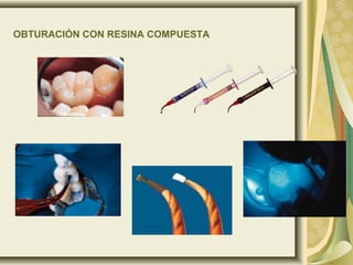 OBTURACIÓN CON RESINA COMPUESTA
 