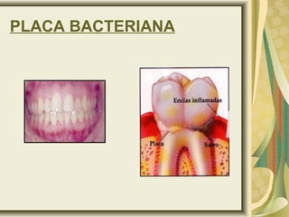 PLACA BACTERIANA
 