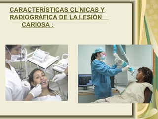 CARACTERÍSTICAS CLÍNICAS Y
RADIOGRÁFICA DE LA LESIÓN
   CARIOSA :
 