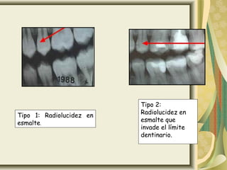 Tipo 2:
Tipo 1: Radiolucidez en   Radiolucidez en
esmalte.                  esmalte que
                          invade el límite
                          dentinario.
 