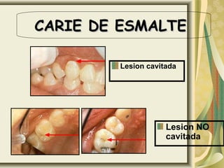 CARIE DE ESMALTE

        Lesion cavitada




                    Lesion NO
                    cavitada
 