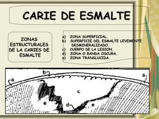 CARIE DE ESMALTE
                  a)   ZONA SUPERFICIAL.
     ZONAS        b)   SUPERFICIE DEL ESMALTE LEVEMENTE
ESTRUCTURALES           DESMINERALIZADO.
DE LA CARIES DE   c)   CUERPO DE LA LESION.
                  d)   ZONA O BANDA OSCURA.
    ESMALTE
                  e)   ZONA TRANSLUCIDA.
 