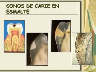 CONOS DE CARIE EN
ESMALTE
 
