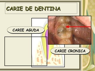 CARIE DE DENTINACARIE DE DENTINA
CARIE AGUDACARIE AGUDA
CARIE CRONICACARIE CRONICA
 