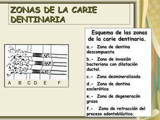ZONAS DE LA CARIEZONAS DE LA CARIE
DENTINARIADENTINARIA
A B C D E F
Esquema de las zonasEsquema de las zonas
de la carie dentinaria.de la carie dentinaria.
a.- Zona de dentinaa.- Zona de dentina
descompuestadescompuesta
b.- Zona de invasiónb.- Zona de invasión
bacteriana con dilataciónbacteriana con dilatación
ductal.ductal.
c.- Zona desmineralizadac.- Zona desmineralizada
d.- Zona de dentinad.- Zona de dentina
escleróticaesclerótica
e.- Zona de degeneracóne.- Zona de degeneracón
grasagrasa
f.- Zona de retracción delf.- Zona de retracción del
proceso odontoblásticoproceso odontoblástico..
 