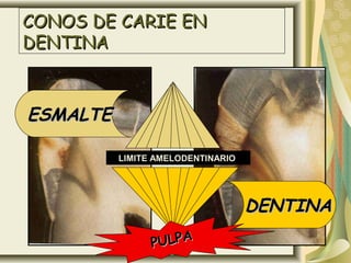 CONOS DE CARIE ENCONOS DE CARIE EN
DENTINADENTINA
ESMALTEESMALTE
LIMITE AMELODENTINARIOLIMITE AMELODENTINARIO
DENTINADENTINA
PULPAPULPA
 