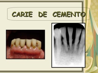 CARIE DE CEMENTOCARIE DE CEMENTO
 
