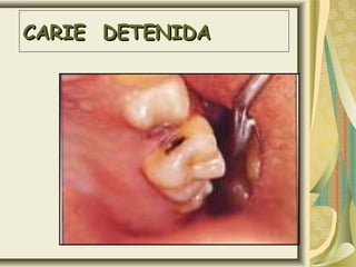 CARIE DETENIDACARIE DETENIDA
 