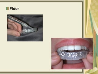 Flúor
 