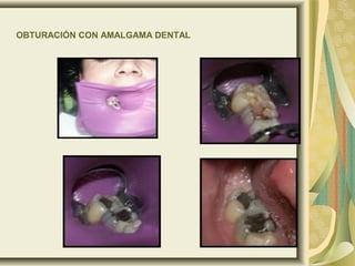 OBTURACIÓN CON AMALGAMA DENTAL
 