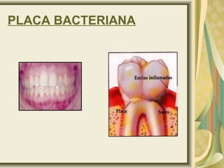 PLACA BACTERIANA
 