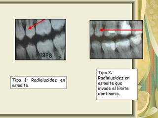 Tipo 1: Radiolucidez en
esmalte.
Tipo 2:
Radiolucidez en
esmalte que
invade el límite
dentinario.
 
