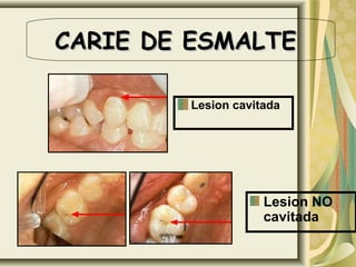 Lesion cavitada
CARIE DE ESMALTECARIE DE ESMALTE
Lesion NO
cavitada
 