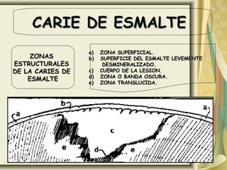 CARIE DE ESMALTECARIE DE ESMALTE
ZONASZONAS
ESTRUCTURALESESTRUCTURALES
DE LA CARIES DEDE LA CARIES DE
ESMALTEESMALTE
a) ZONA SUPERFICIAL.a) ZONA SUPERFICIAL.
b) SUPERFICIE DEL ESMALTE LEVEMENTEb) SUPERFICIE DEL ESMALTE LEVEMENTE
DESMINERALIZADO.DESMINERALIZADO.
c) CUERPO DE LA LESION.c) CUERPO DE LA LESION.
d) ZONA O BANDA OSCURA.d) ZONA O BANDA OSCURA.
e) ZONA TRANSLUCIDA.e) ZONA TRANSLUCIDA.
 