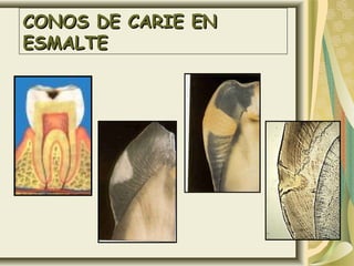 CONOS DE CARIE ENCONOS DE CARIE EN
ESMALTEESMALTE
 