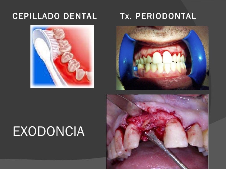 Caries y Endocarditis Bacteriana